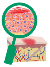 Vista ampliada de las células de la piel en pacientes con eczema moderado a grave no controlado (dermatitis atópica)