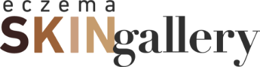 Eczema Skin Gallery