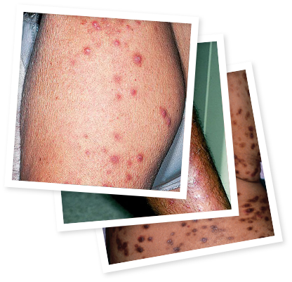 Pictures of prurigo nodularis (PN) on various skin tones and different body parts