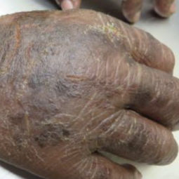 Moderate-to-Severe eczema on dark, brown, black skin on hands