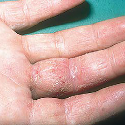 Moderate-to-Severe eczema on light, white, pale, fair skin on hand