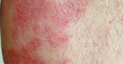 Moderate-to-severe eczema on white skin manifesting as bumps and rashes