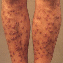 Prurigo nodularis (PN) on a patient's legs who is not on DUPIXENT® (dupilumab)