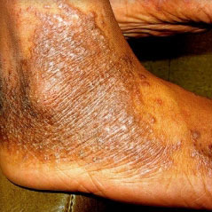 Pictures of moderate-to-severe eczema on various skin tones and different body parts