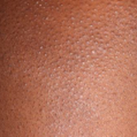 Moderate-to-Severe eczema on dark, brown, black skin on arm