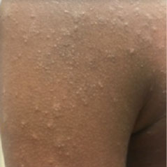 Pictures of moderate-to-severe eczema on various skin tones and different body parts