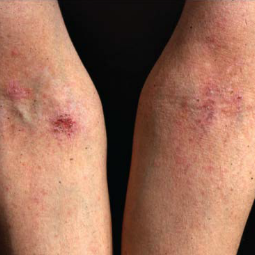 Moderate-to-Severe eczema on light, white, pale, fair skin on arms