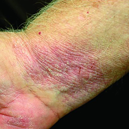 Moderate-to-Severe eczema on light, white, pale, fair skin on wrist