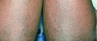 Moderate-to-severe eczema on dark/black skin manifesting as bumps and rashes on legs