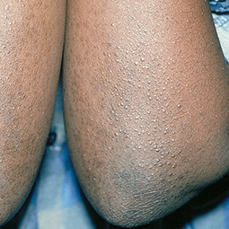 Moderate-to-Severe eczema on dark, brown, black skin on arms