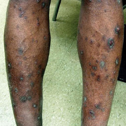 Prurigo nodularis (PN) bumps on a patient's legs who is not on DUPIXENT® (dupilumab)