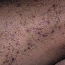 Prurigo nodularis (PN) on a patient's leg who is not on DUPIXENT® (dupilumab)