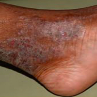 Moderate-to-Severe eczema on dark, brown, black skin on ankle