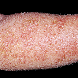 Moderate-to-Severe eczema on light, white, pale, fair skin on arm