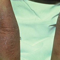 Moderate-to-Severe eczema on dark, brown, black skin on arm