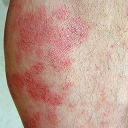 Moderate-to-Severe eczema on light, white, pale, fair skin on leg
