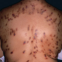 prurigo nodularis (PN) on a patient's back who is not on DUPIXENT® (dupilumab)