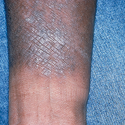 Moderate-to-Severe eczema on dark, brown, black skin on arm