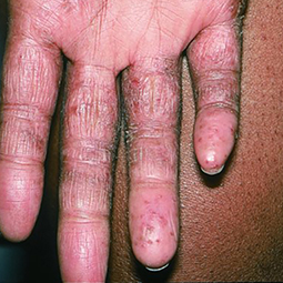 Moderate-to-Severe eczema on dark, brown, black skin on hand
