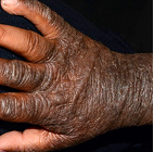 Moderate-to-Severe eczema on dark, brown, black skin on hand