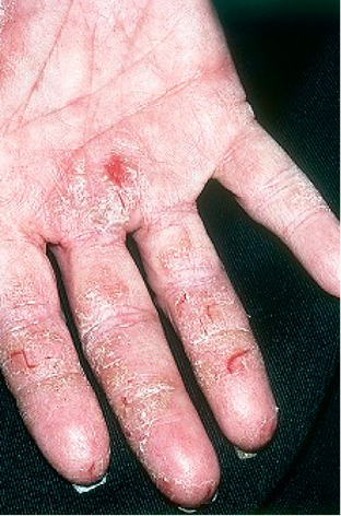 Moderate-to-Severe eczema on light, white, pale, fair skin on hand