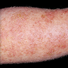 Pictures of moderate-to-severe eczema on various skin tones and different body parts