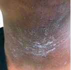 Moderate-to-Severe eczema on dark, brown, black skin on neck