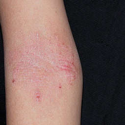 Moderate-to-Severe eczema on light, white, pale, fair skin on arm
