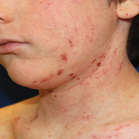 Moderate-to-Severe eczema on light, white, pale, fair skin on chin & neck