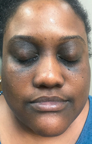 Moderate-to-Severe eczema on dark, brown, black skin on eyes