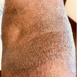 Moderate-to-Severe eczema on dark, brown, black skin on arm