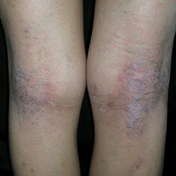 Moderate-to-Severe eczema on light, white, pale, fair skin on legs
