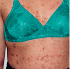 Moderate-to-Severe eczema on light, white, pale, fair skin on chest