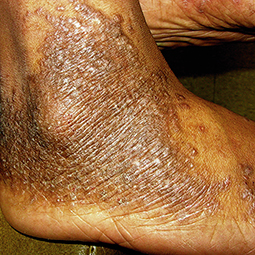 Moderate-to-Severe eczema on dark, brown, black skin on ankle