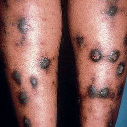 Prurigo nodularis (PN) on a patient's legs who is not on DUPIXENT® (dupilumab)
