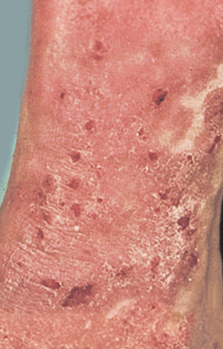 Moderate-to-Severe eczema on light, white, pale, fair skin on arm