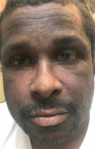 Moderate-to-Severe eczema on dark, brown, black skin on face