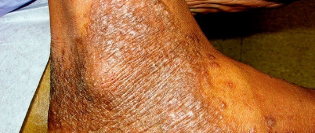 Moderate-to-severe eczema on dark/black skin manifesting as bumps and rashes on ankle