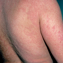 Moderate-to-Severe eczema on light, white, pale, fair skin on arm and upper back