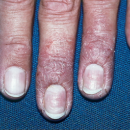 Moderate-to-Severe eczema on dark, brown, black skin on fingers