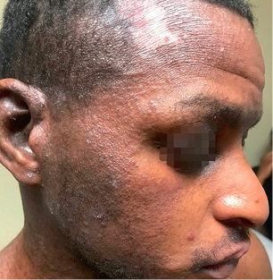 Moderate-to-Severe eczema on dark, brown, black skin on face