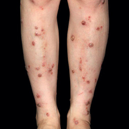 Prurigo nodularis (PN) on a patient's legs who is not on DUPIXENT® (dupilumab)